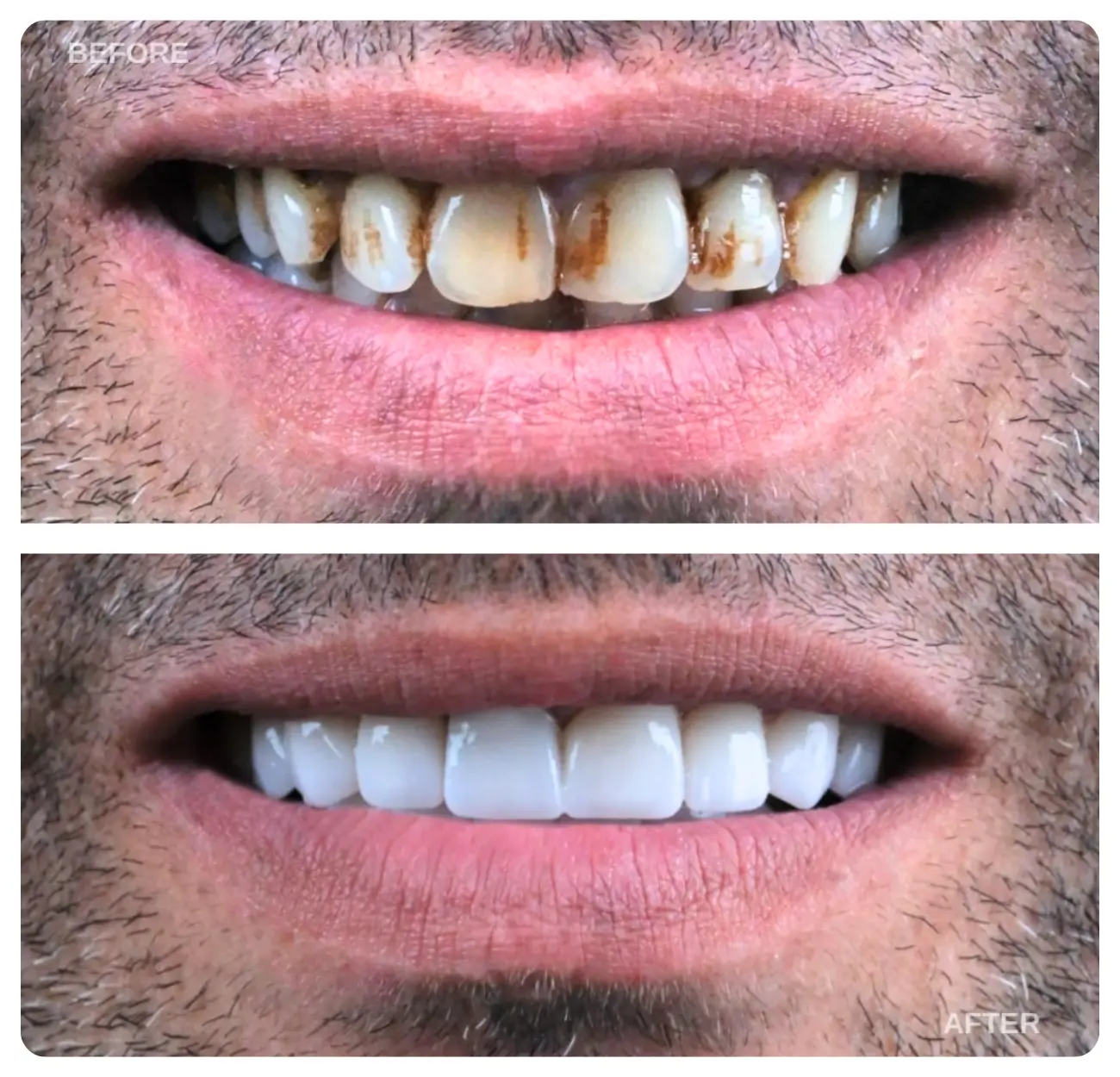 dental veneers turkey