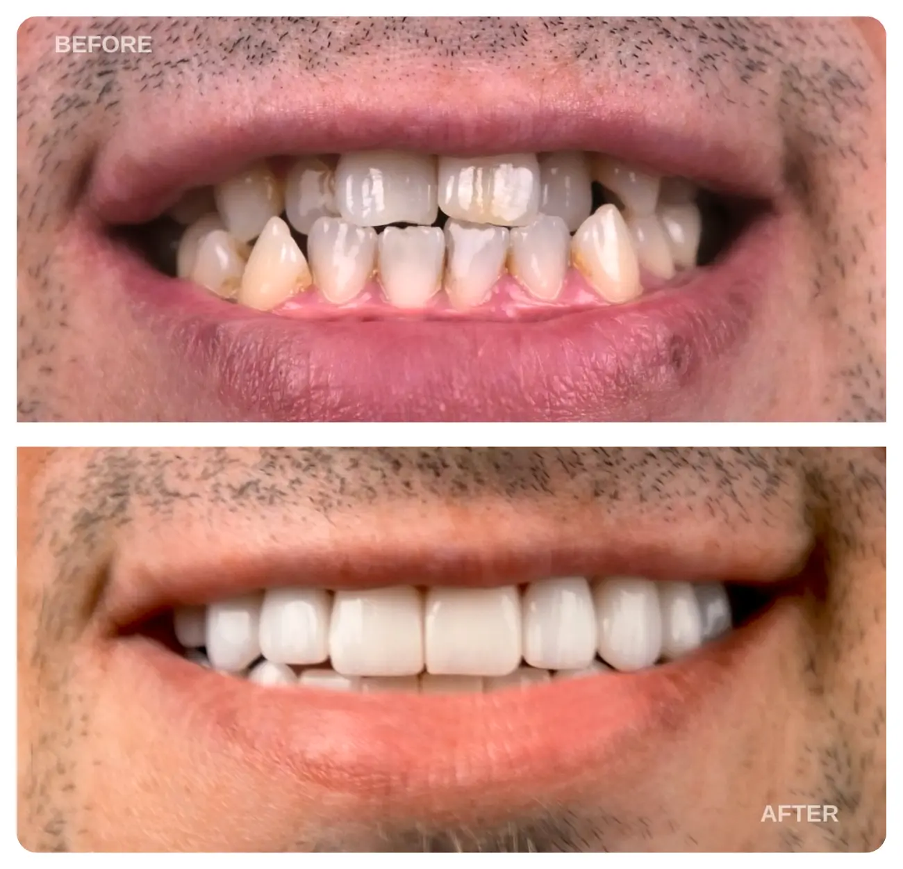 dental implants turkey