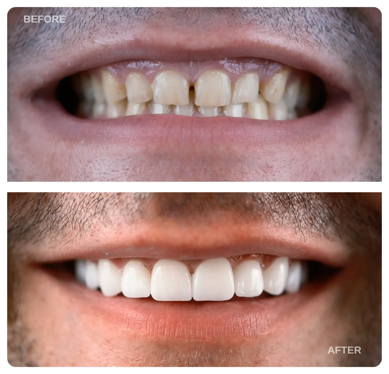 dental implants turkey