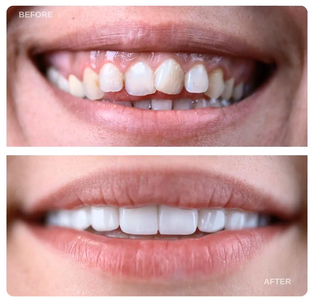 dental implants turkey