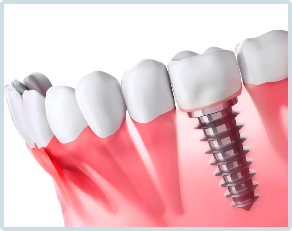 dental implants turkey