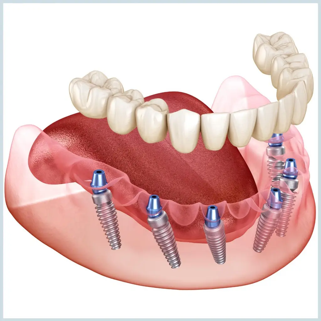 dental implant turkey