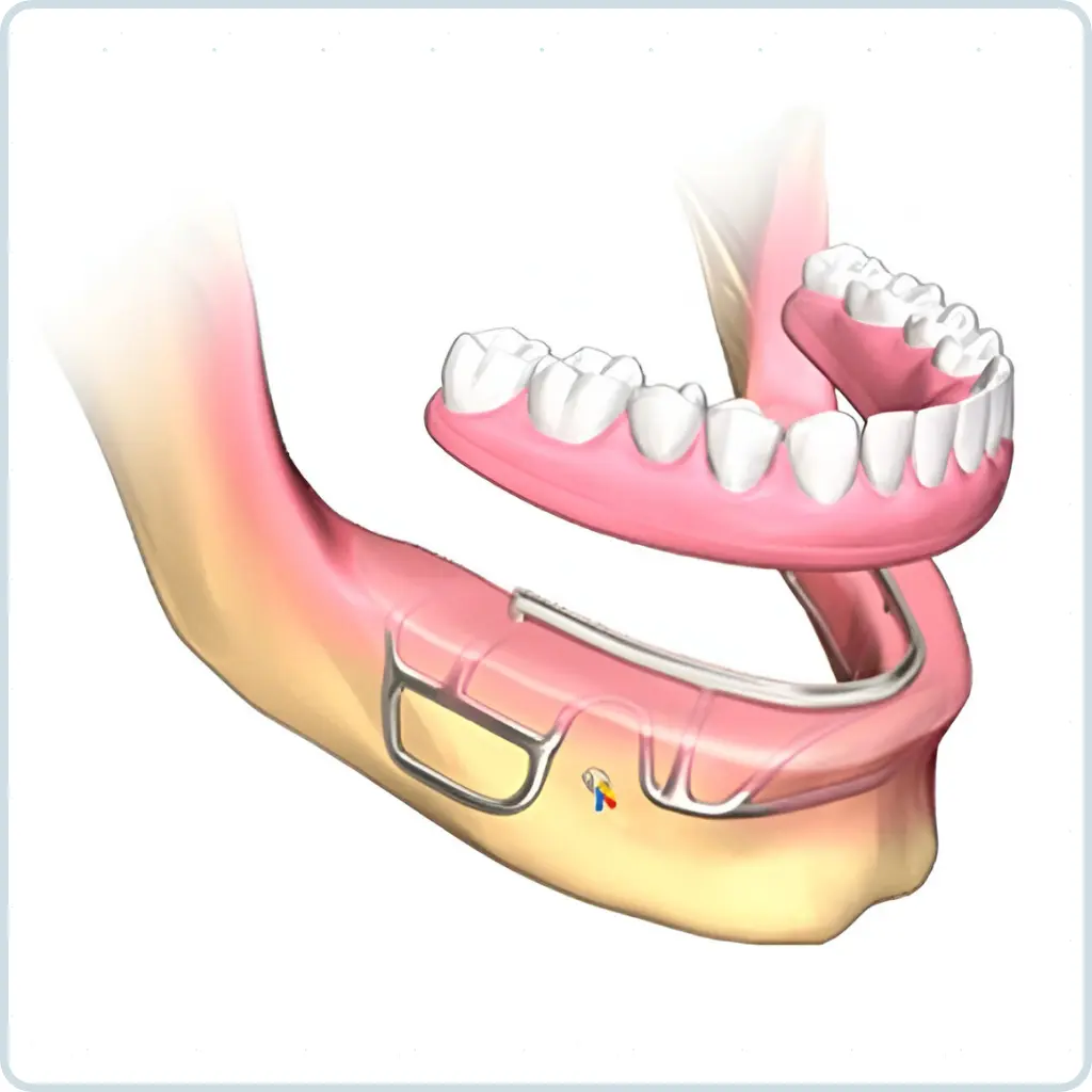 dental implants turkey cost