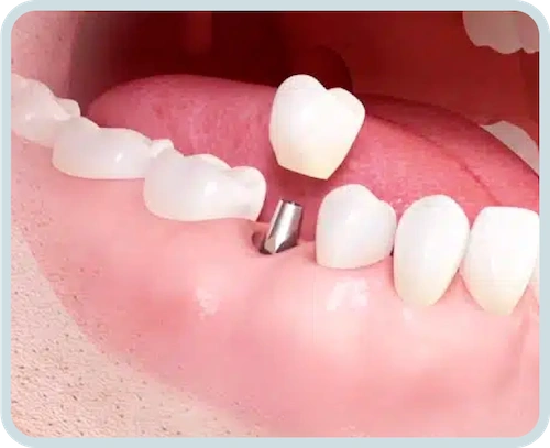 dental implants in turkey