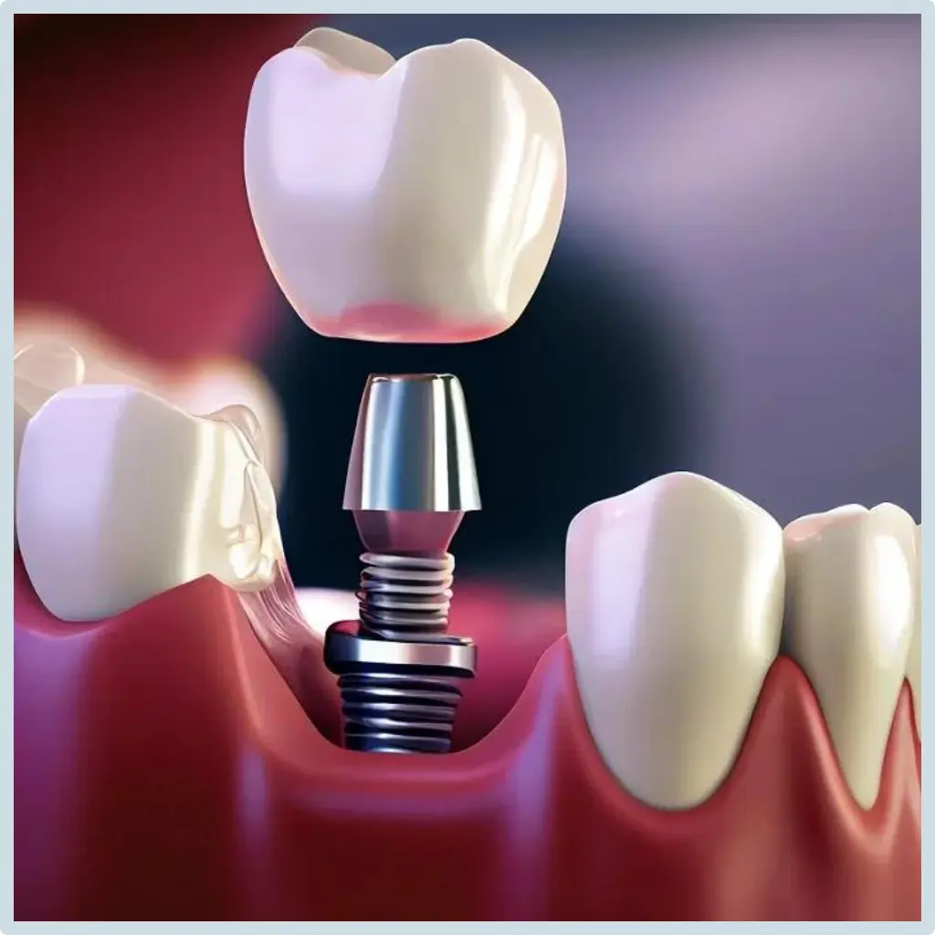 dental implants turkey cost